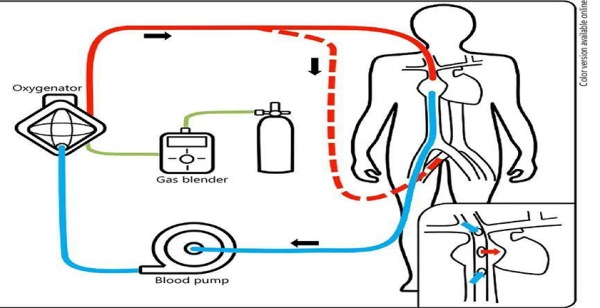 心肺轉(zhuǎn)流術